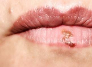 Почему трескаются губы — причины и лечение Губы часто сохнут и трескаются
